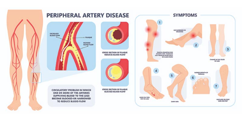 Syptoms and explanation Graphic of peripheral artery disease